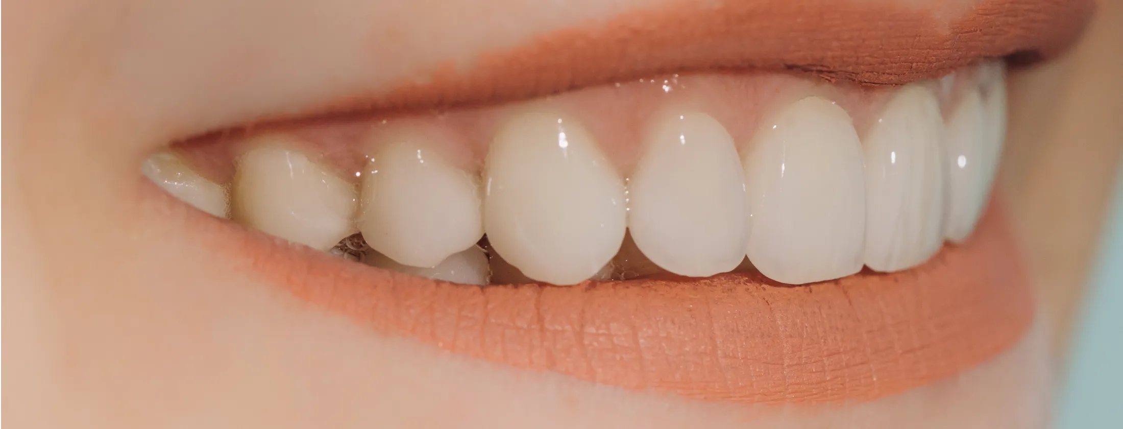 1. 審美歯科セラミック治療は“見た目を整えるだけ”ではありません