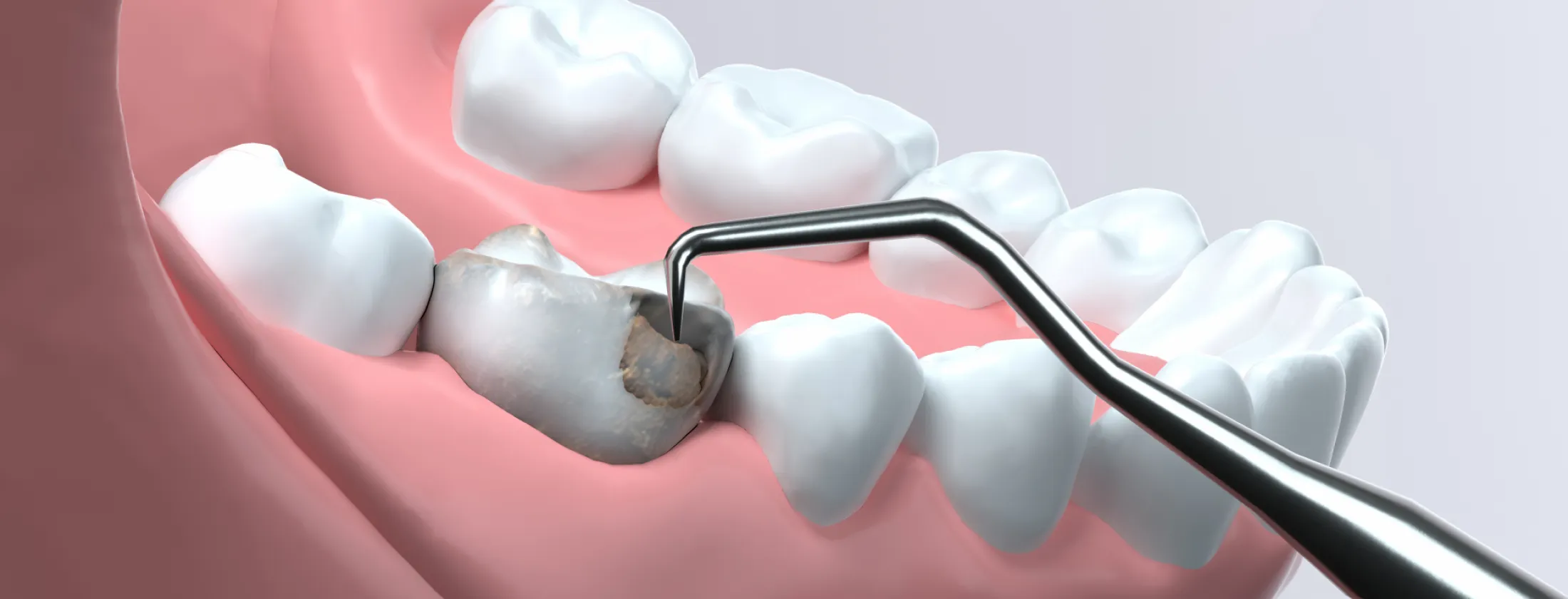 3.LOTUS DENTAL CLINIC東京の重度虫歯治療の特徴