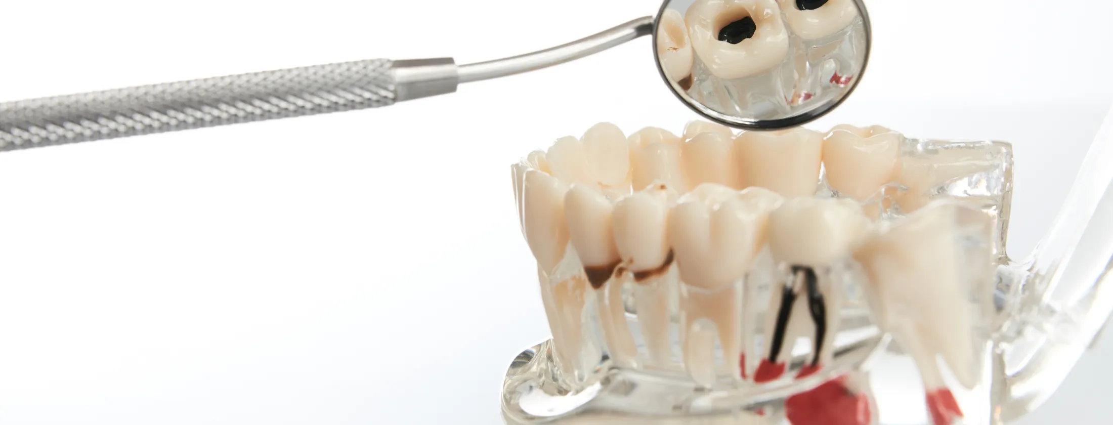 7.当院の重度虫歯治療の具体的なメニュー