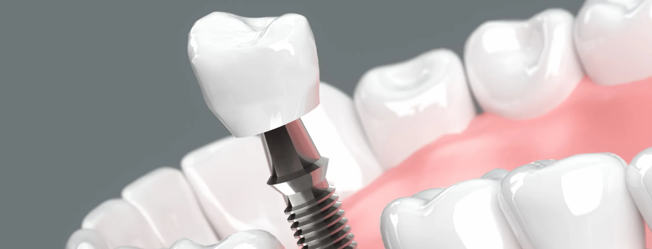 1.インプラント治療で“失った歯の未来”は取り戻せる