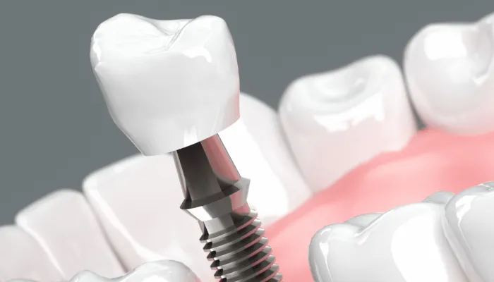 1.インプラント治療で“失った歯の未来”は取り戻せる