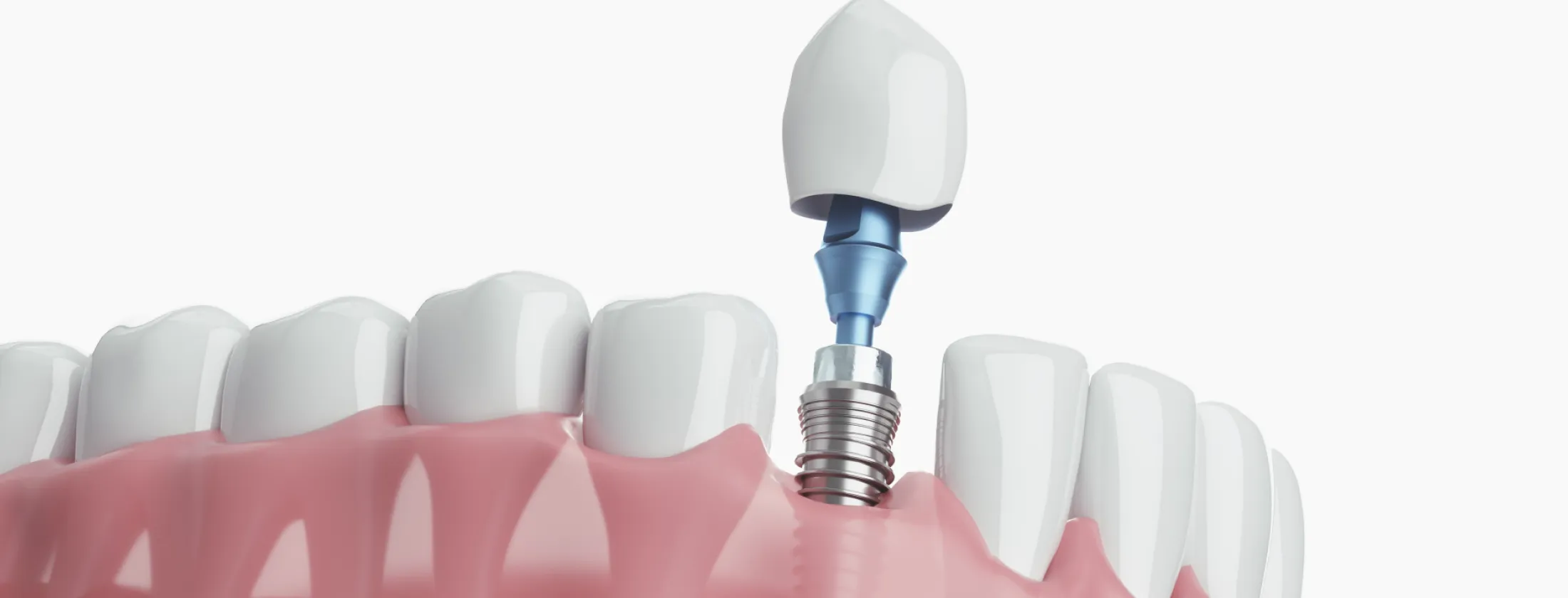 3.当院のインププラント治療が選ばれる理由