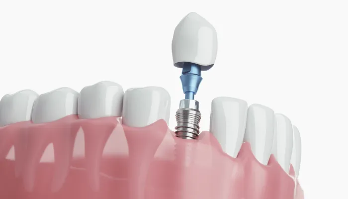 3.当院のインププラント治療が選ばれる理由