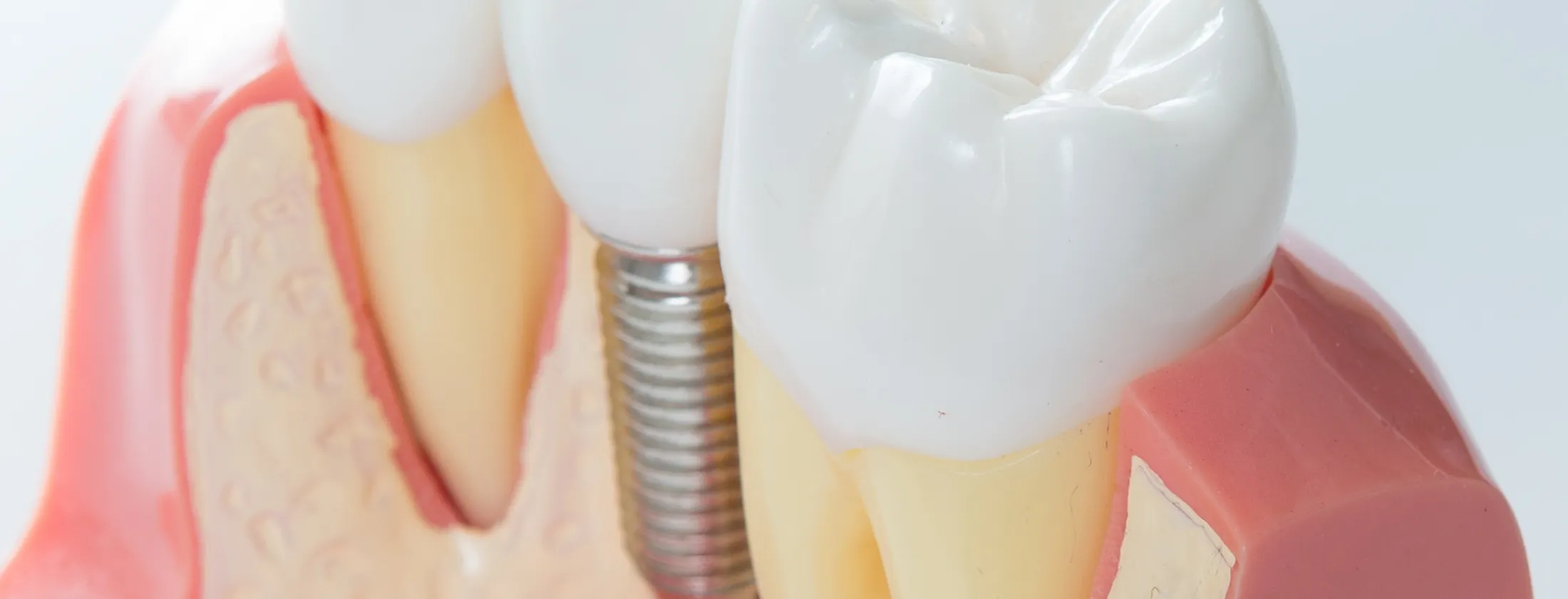 7. 再生療法とインプラントの違い