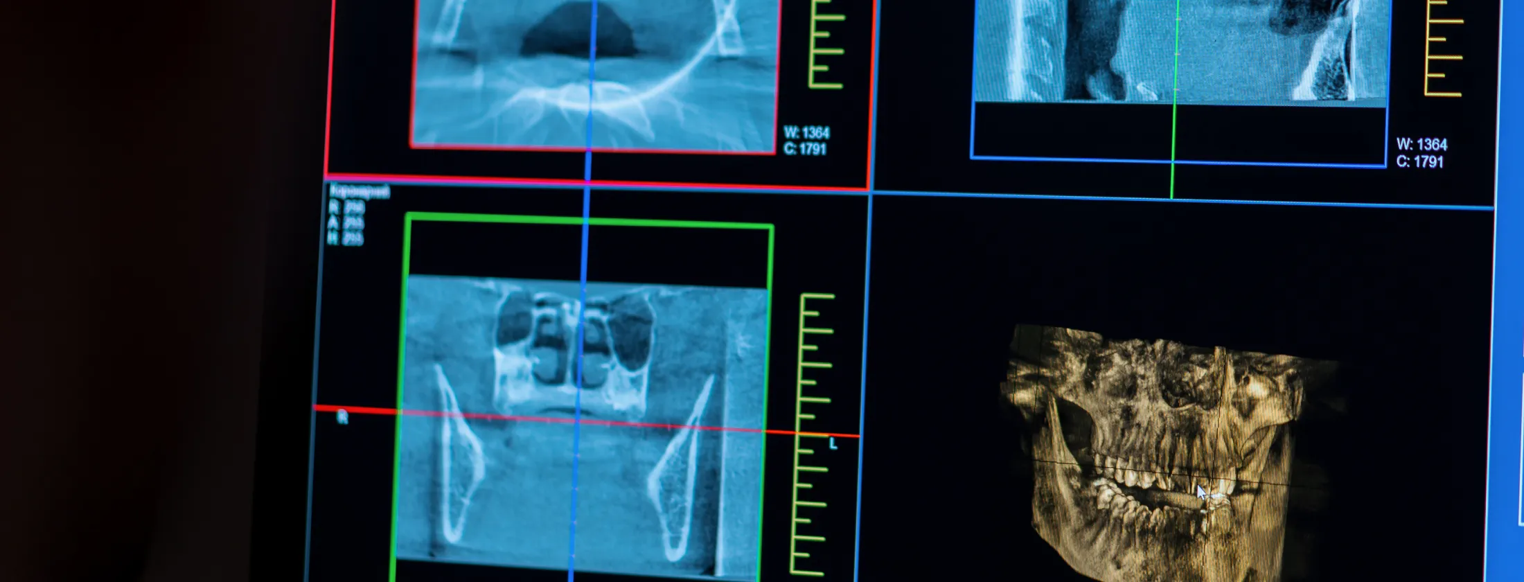 3.自家歯牙移植が適応されるケースとは