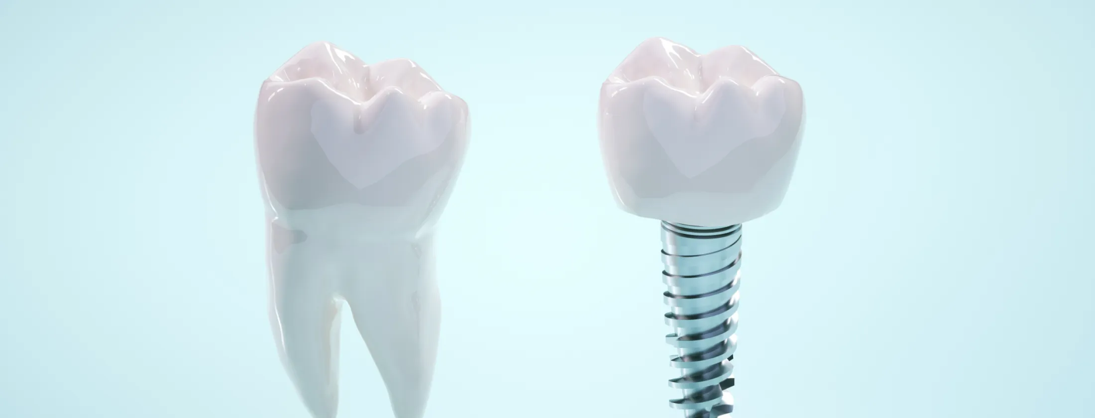 5.自家歯牙移植のメリットと、インプラントとの本質的な違い