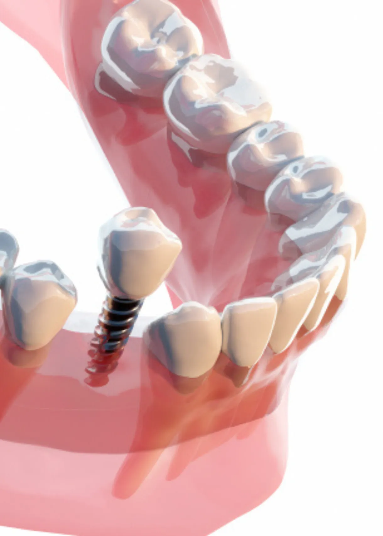 失われた歯の機能を再構築する インプラント治療