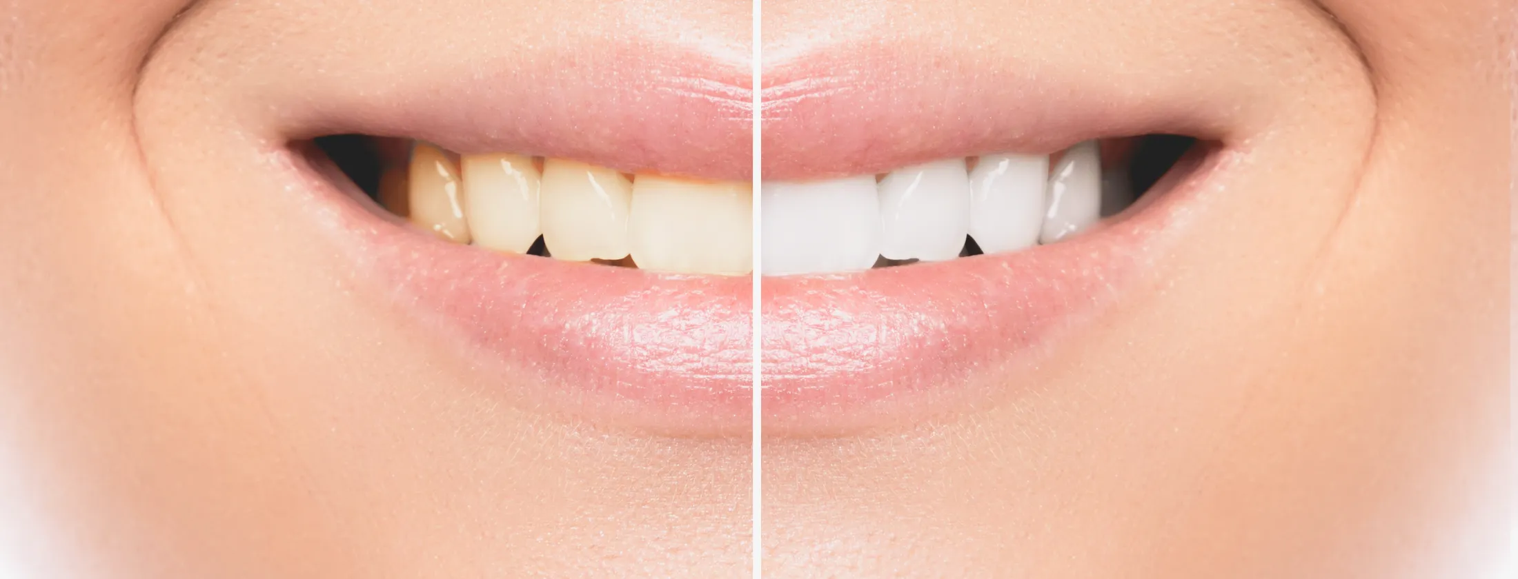 ②歯の黄ばみはなぜ起こるのか？