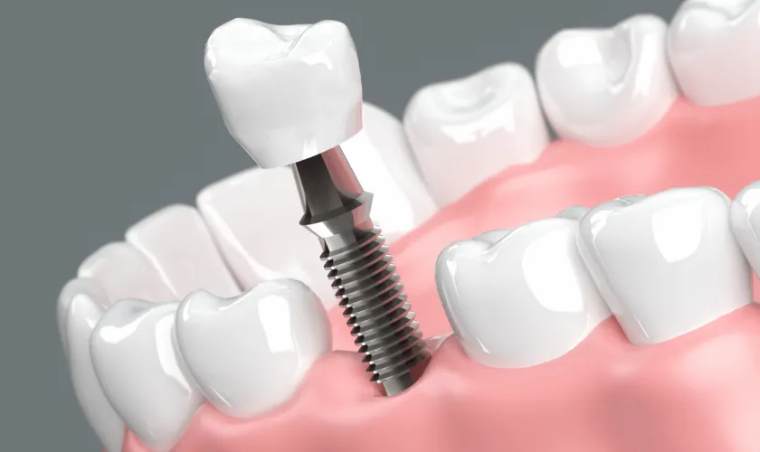 外科的処置（インプラント・再生療法）