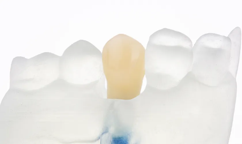 仮歯への置き換え・咬合調整