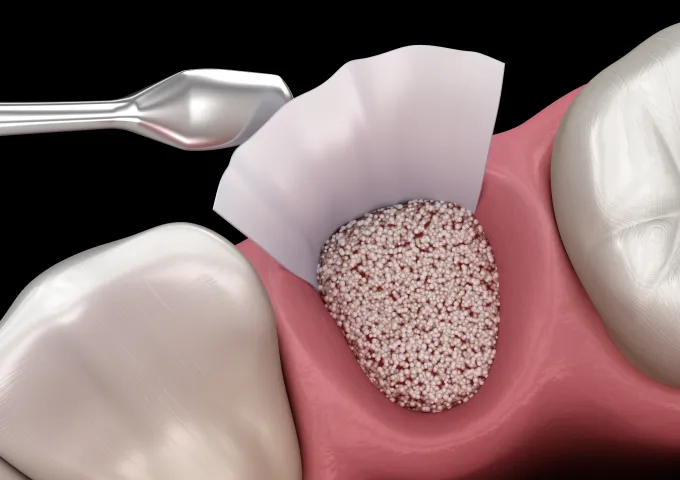 GBR法（骨再生誘導法）による骨量回復