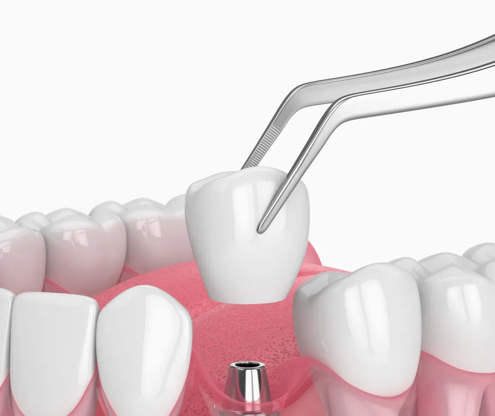 抜歯か保存かを、データで見極める全顎診断