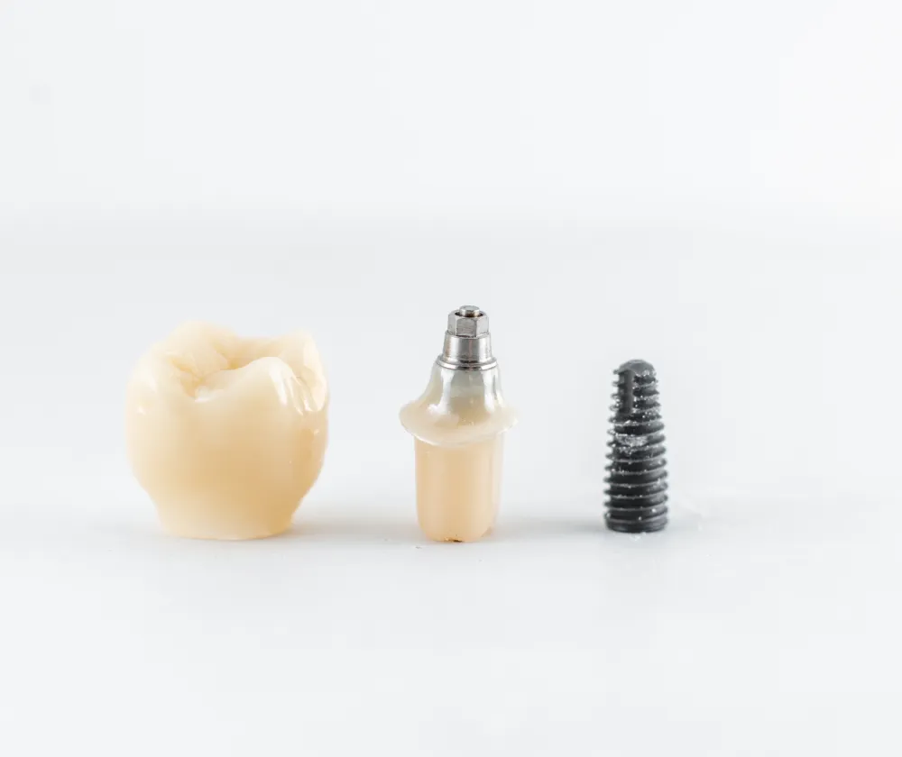 全顎治療におけるインプラント治療