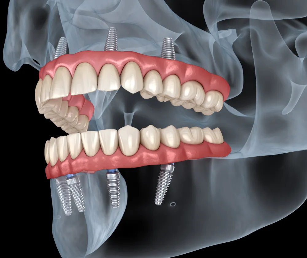 全顎治療における骨再生・歯周再生