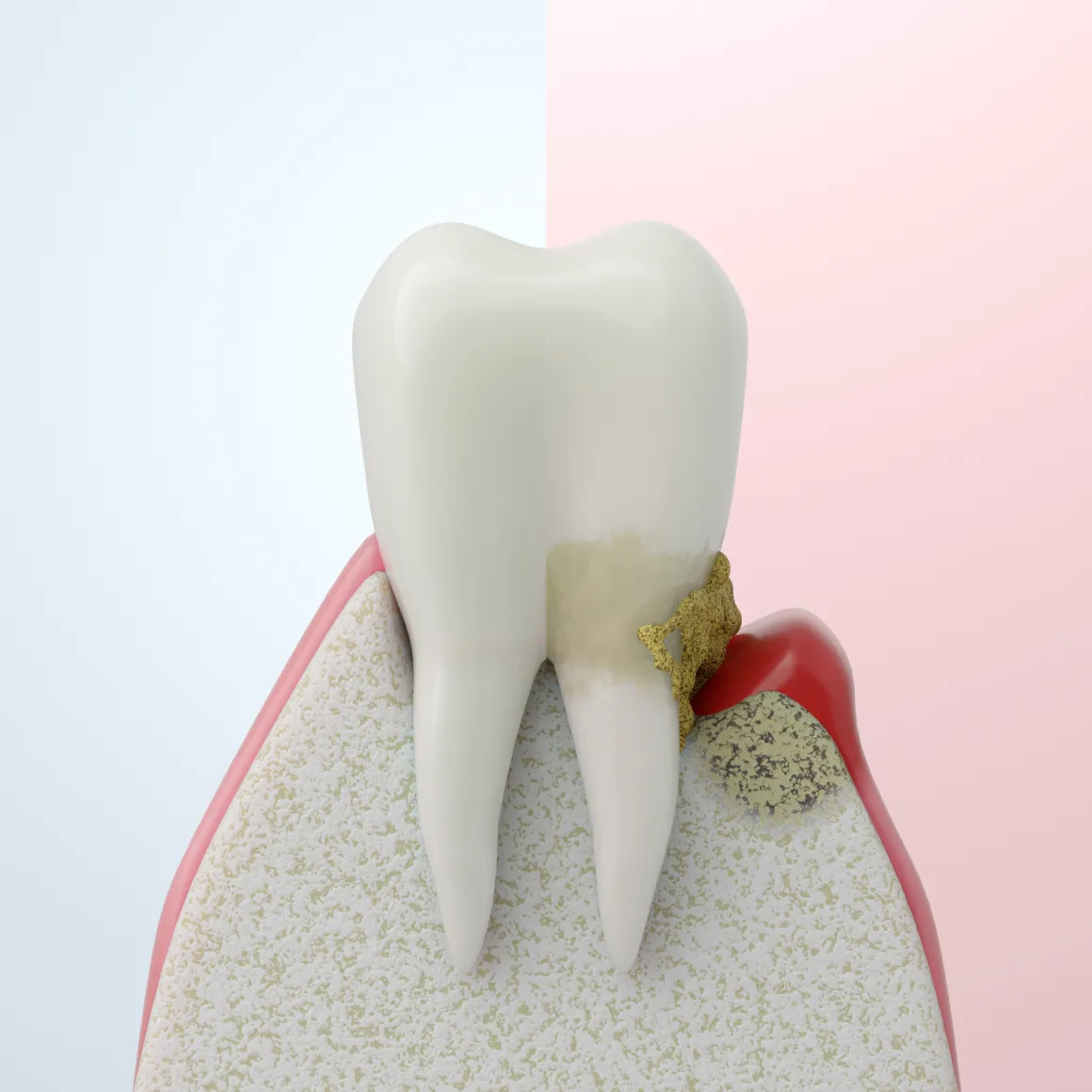 なぜ、私たちはこれほどまでに「歯周病治療」を重要視するのか。
