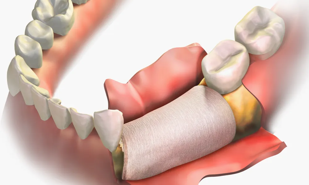重度歯周病治療におけるGTR法（組織再生誘導法）