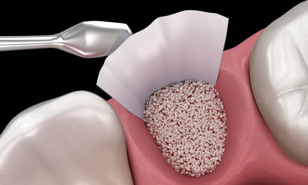 重度歯周病治療におけるGBR法（骨再生誘導法）