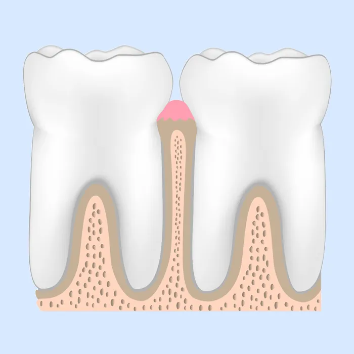 健康な歯肉（Healthy Gingiva）