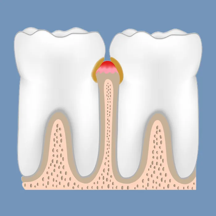 歯肉炎（Gingivitis）
