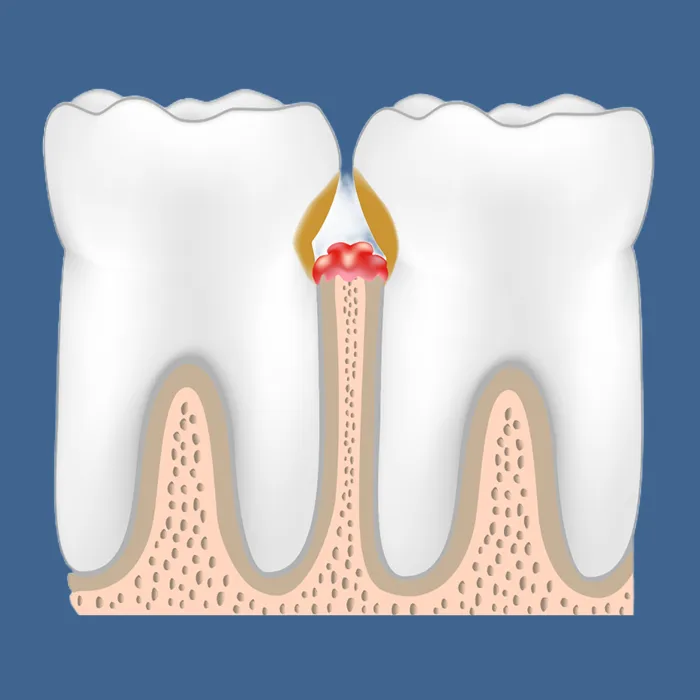 歯周炎（Periodontitis）