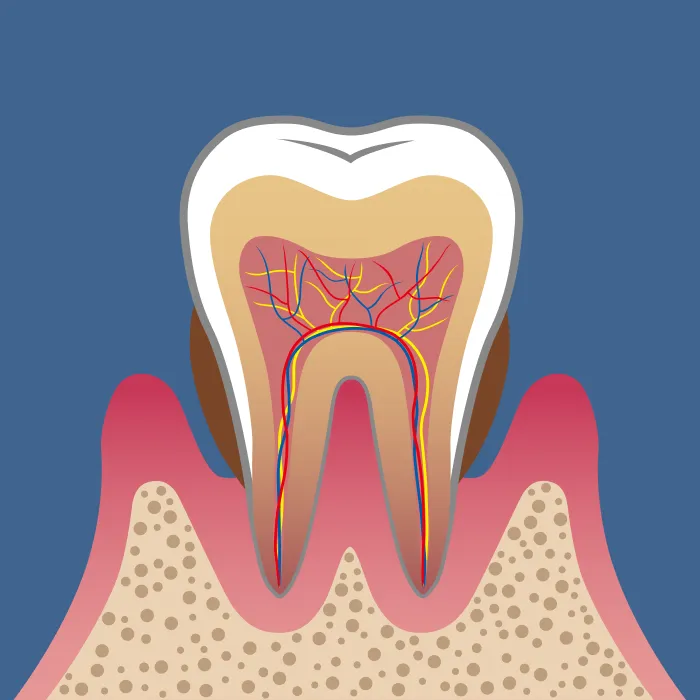 中等度歯周炎（Moderate Periodontitis）