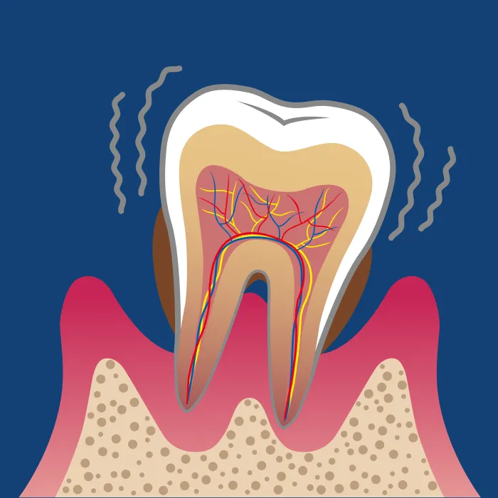 重度歯周炎（Severe Periodontitis）