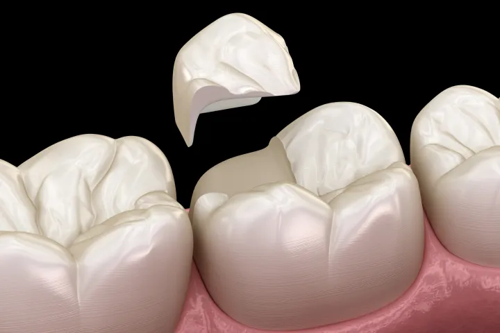 土台構築・被せ物（補綴）