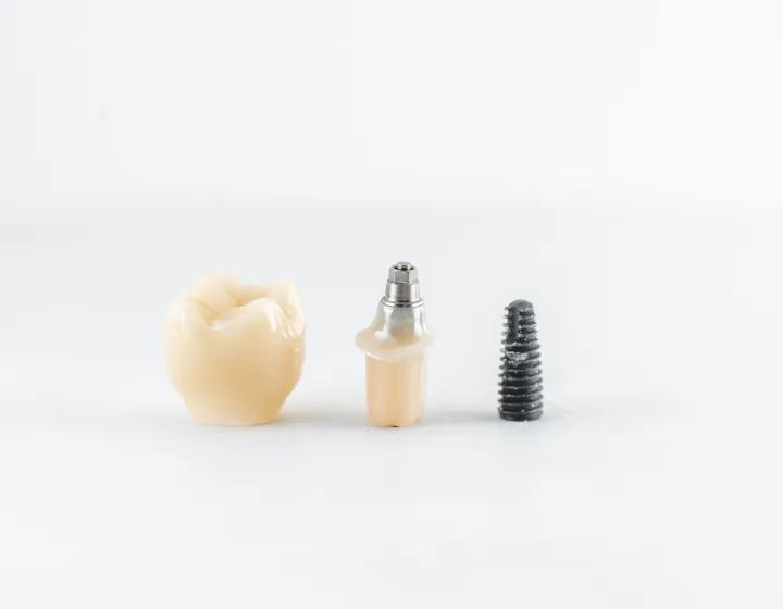 【方針の相違】 「インプラント優先」という選択肢