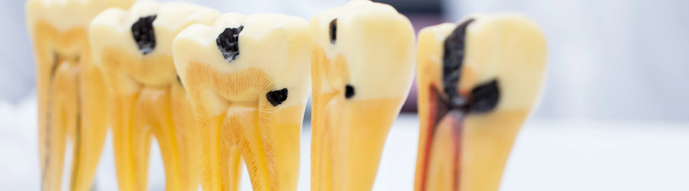 なぜ、日本の根管治療は再発が多いのか？