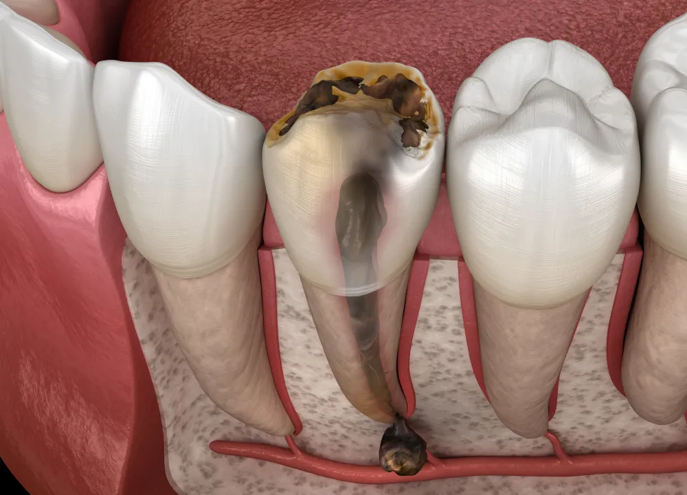 感染の恐怖放置すれば「骨」まで溶かす