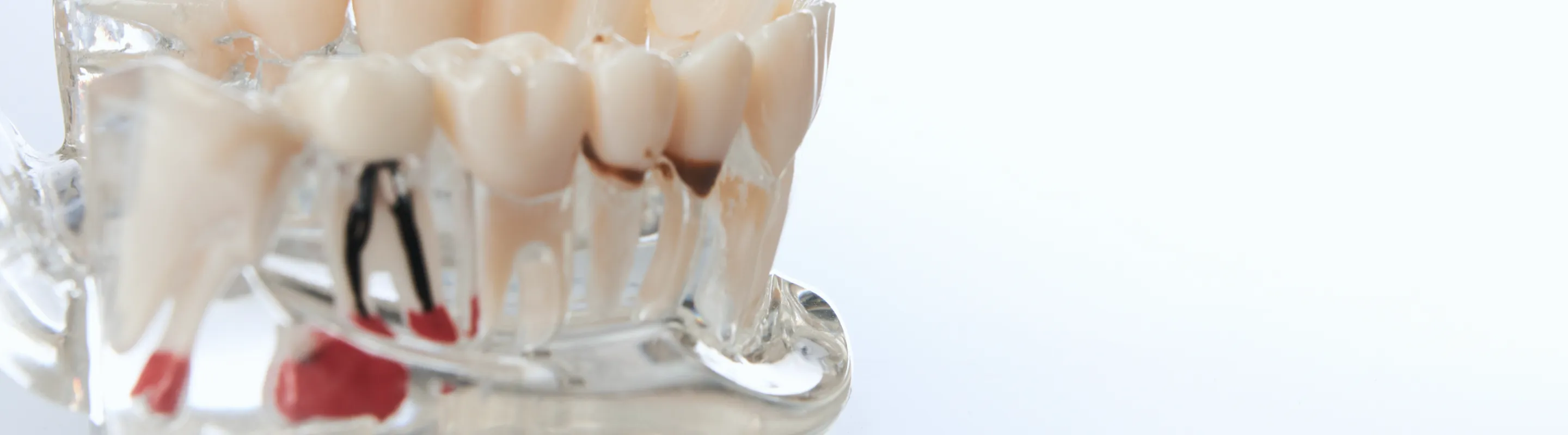 根管治療（歯内療法）とは？