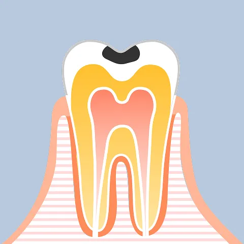 エナメル質の溶解（要観察・初期治療）