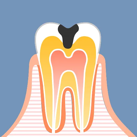 象牙質の汚染（修復治療）
