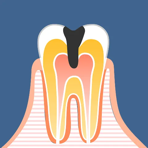 歯髄炎（神経への感染）