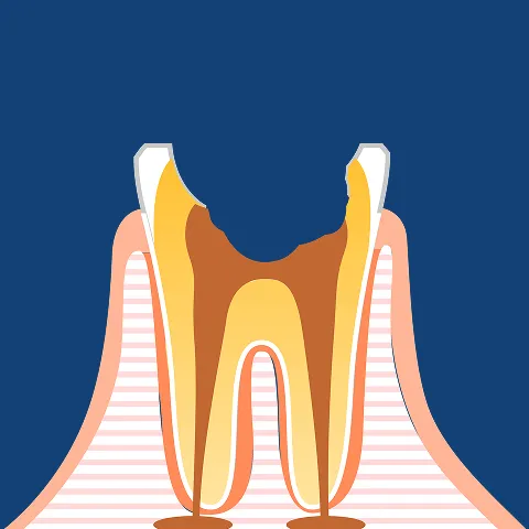 歯質崩壊・残根（保存の限界・抜歯の危機）